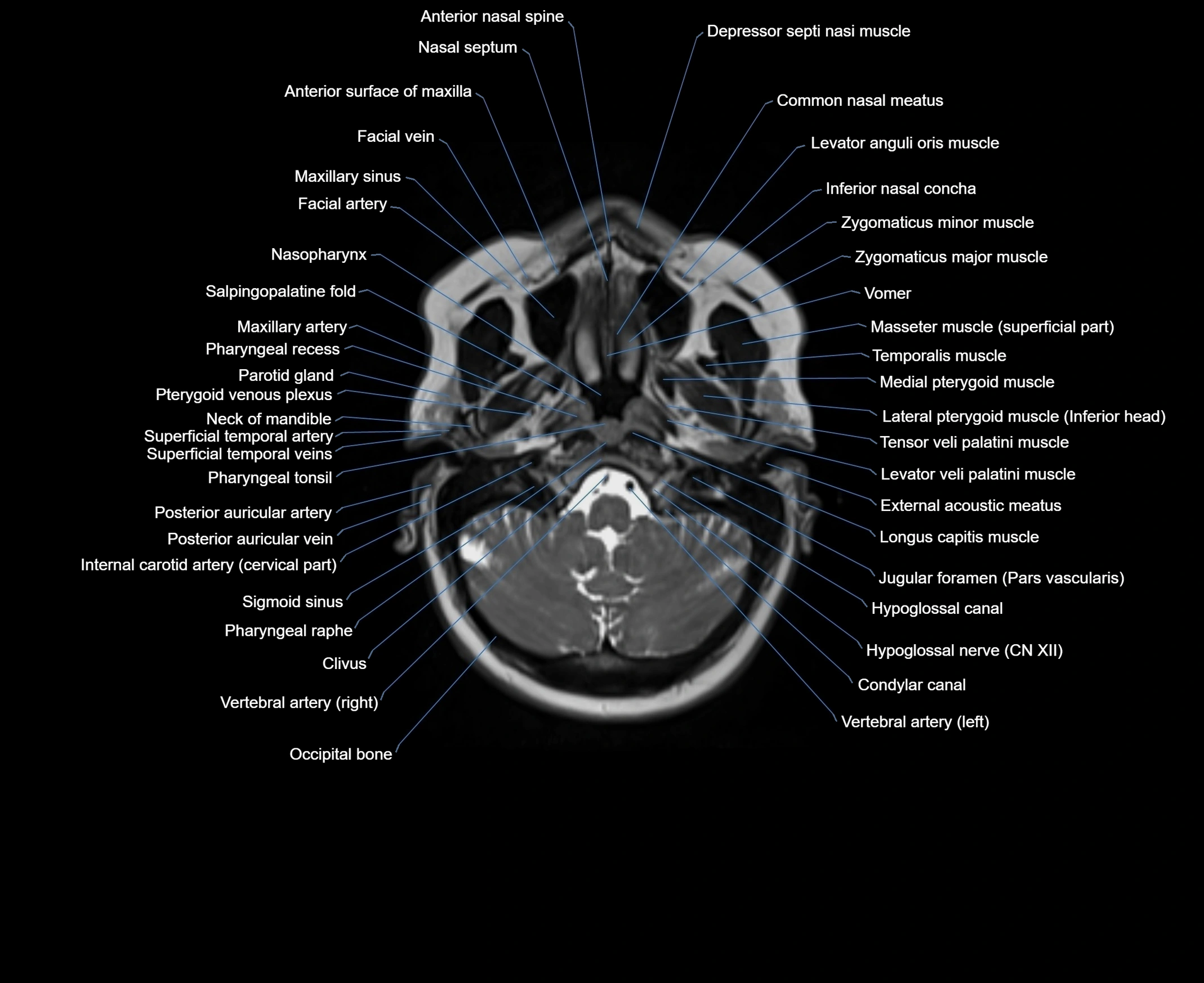 MRI Neck 3D labelled cross section anatomy axial 3t image-00001-00016.webp